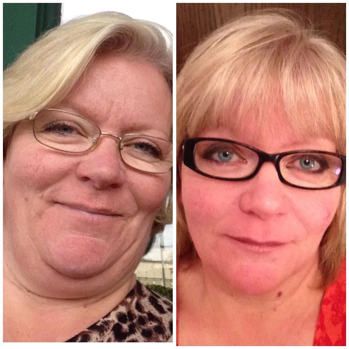 Гипотиреоз лицо до и после. Лицо женщины с гипотиреозом.