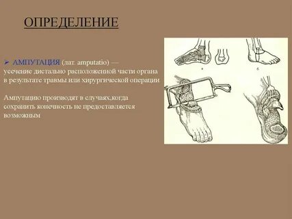 Диагноз ампутация нижних конечностей