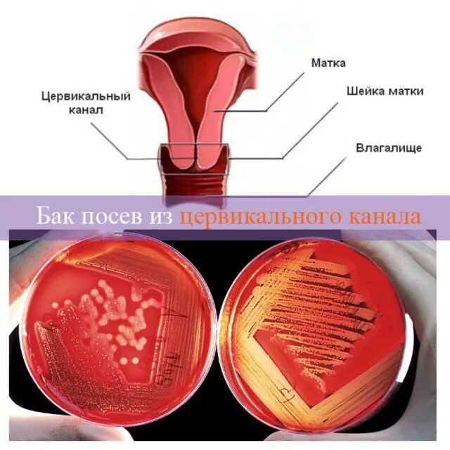 Бак посев из цервикального канала. Бактериальный посев из цервикального канала. Бактериологическое исследование из цервикального канала. Посев материала из цервикального канала. Цервикальный канал размеры