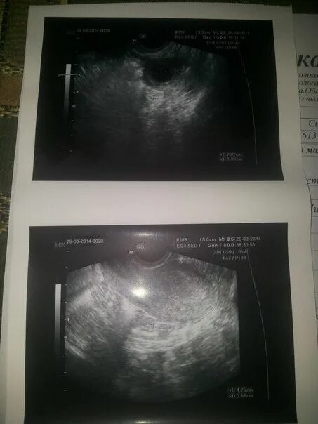 5 дней беременности узи и тест. первое узи после подсадки эмбриона пятидневки. на узи ничего не видно. узи на 6 день задержки. маточная беременность узи.