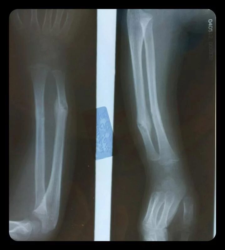 Рентген руки перелом со смещением. Перелом лучевой кости со смещением рентген. Перелом верхней трети лучевой кости рентген. Гипсование перелом малоберцовой кости.