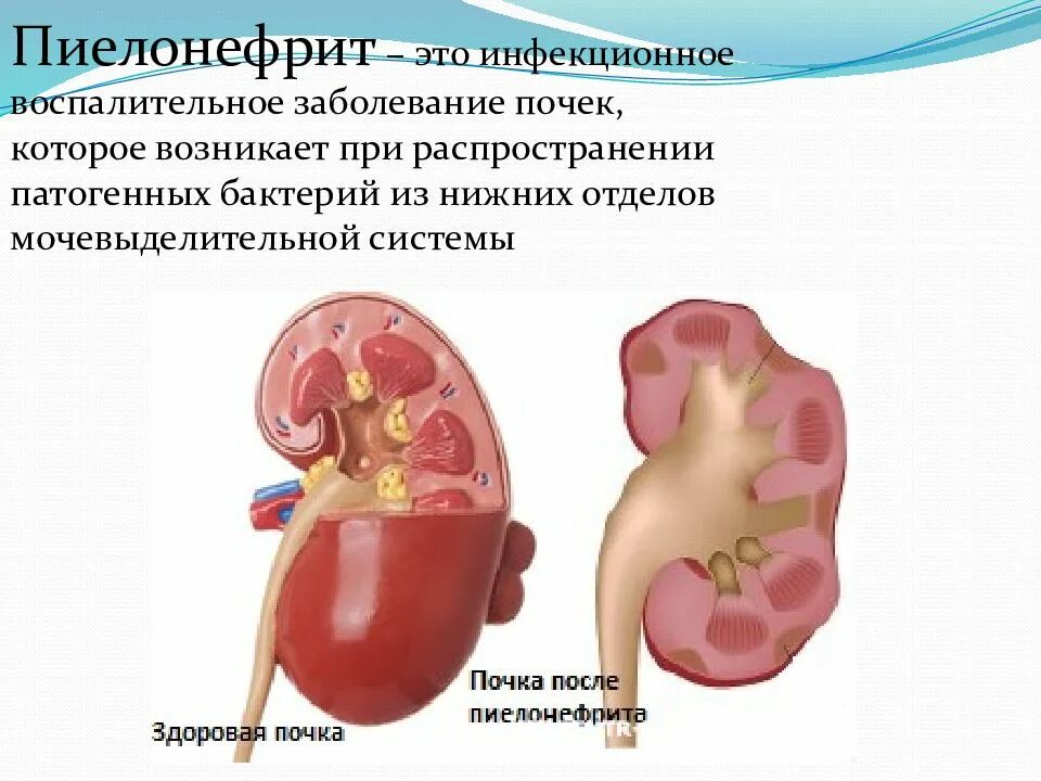 Воспалительные заболевания почек. Заболевание почек пиелонефрит.