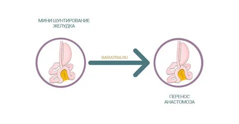 Как получить квоту на шунтирование