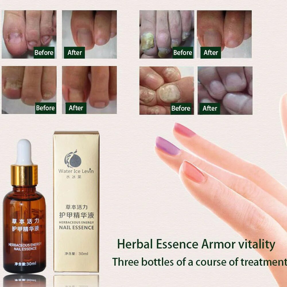 Tonisabery Nail Repair Essence Nail treatment Anti. Oedo косметика Herbal Nail treatment Essence. Китайское средство для снятия ногтя. Эссенция для ухода за ногтями.