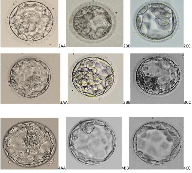 Подсаживали 2 эмбриона. Бластоциста 4аа. Эмбрион бластоциста 3аа. Бластоциста на 5 день. Бластоциста эмбрион 4 АА.