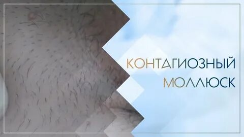 Как удалить моллюск