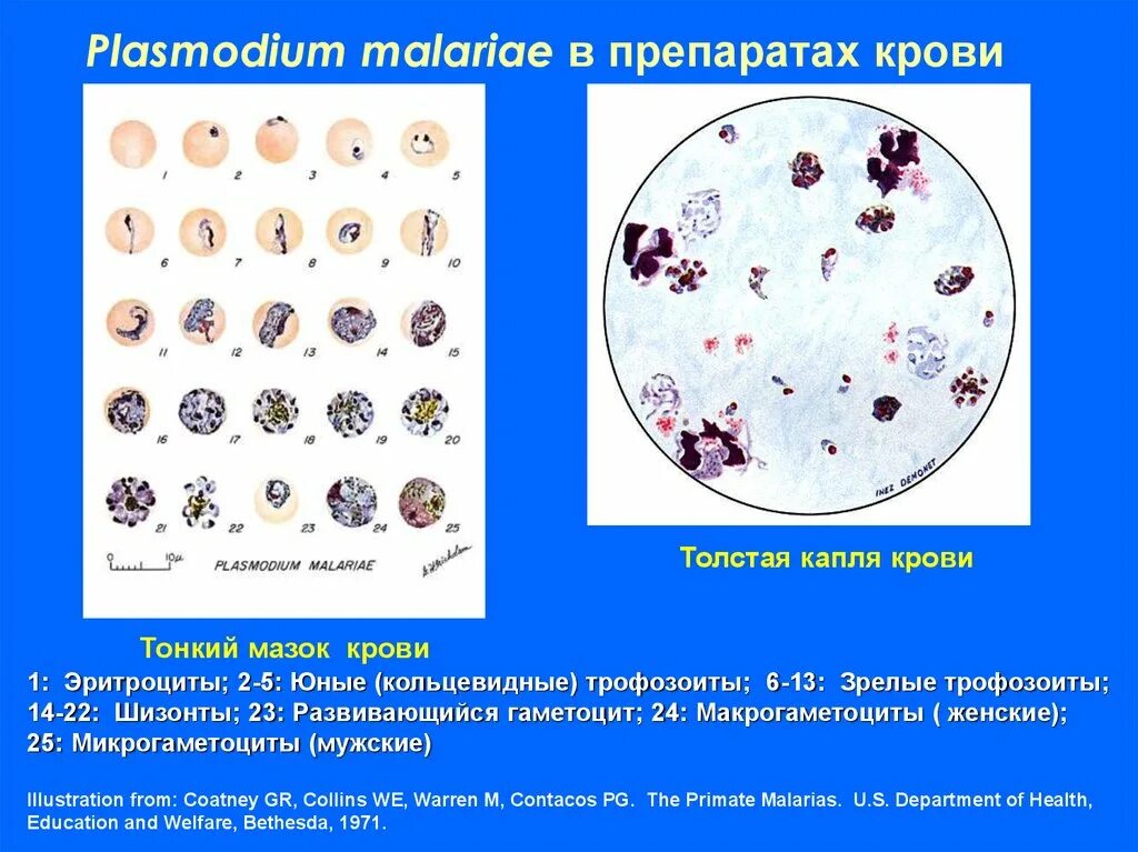 Микрогаметоцит это. Плазмодии малярии в толстой капле крови. Малярийный плазмодий возбудитель. Анализ толстой капли крови на малярийный плазмодий. Малярийный плазмодий микроскопия.