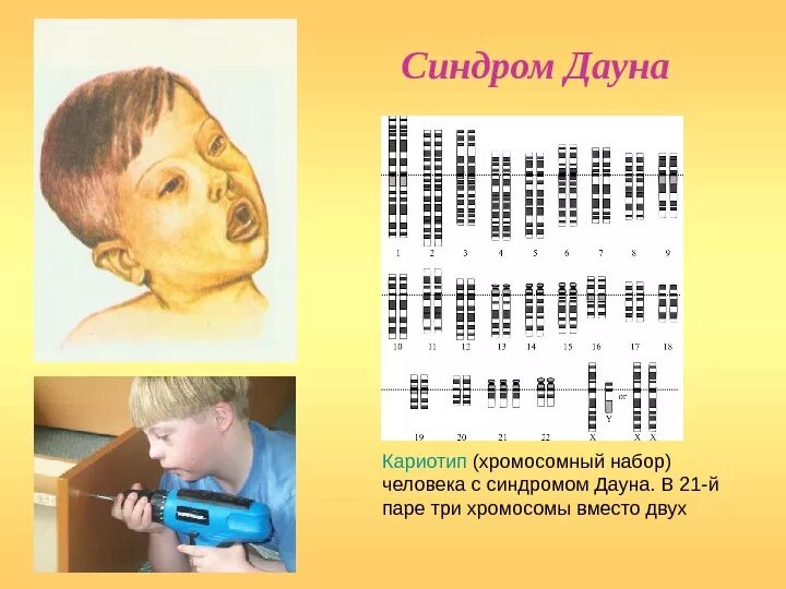 Кариотип человека с синдромом Дауна. Синдром Дауна хромосомный набор. Набор хромосом у даунов.