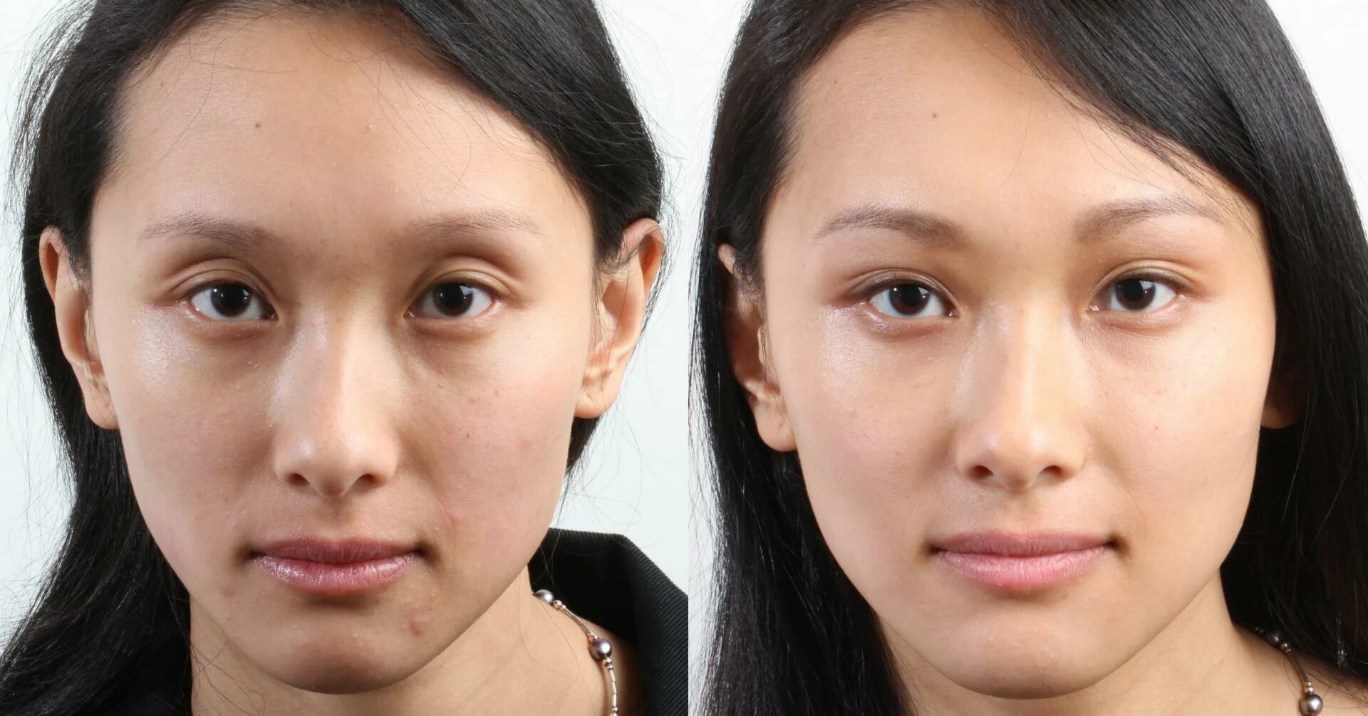 Филлеры под глаза до и после. Европейцы с эпикантусом. Морщины до после азиатки.