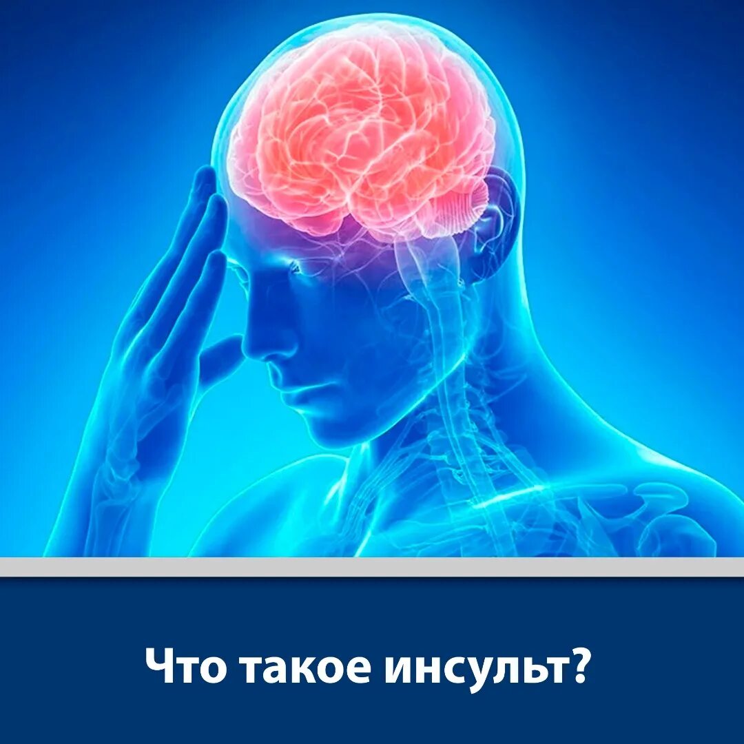 Инсульт картина. Инсульт. Нарушение мозгового кровообращения. Инсульт картинки.