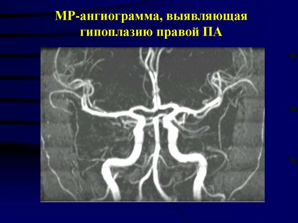 Гипоплазия позвоночной артерии. Гипоплазия почечной артерии.