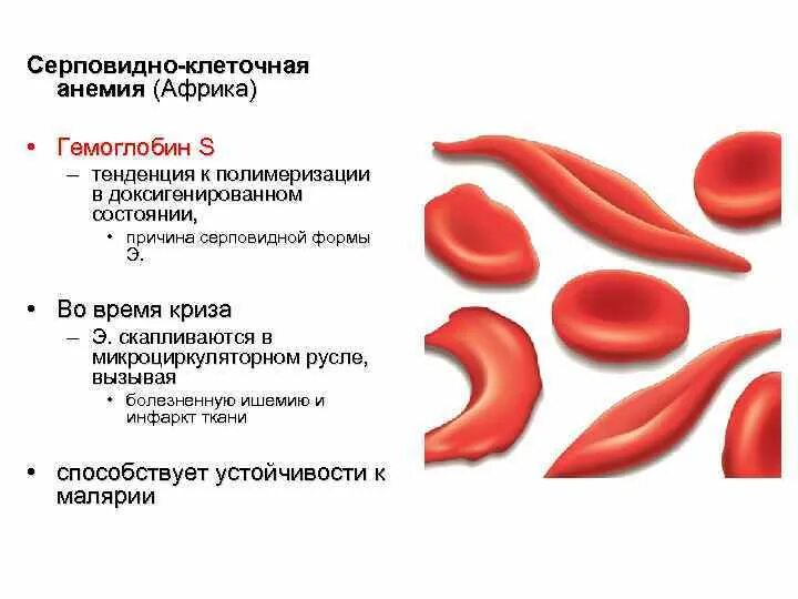 Серповидноклеточная анемия формы. Серповидная анемия эритроциты. Серповидная клеточная анемия гемоглобин. Серповидноклеточная анемия эритроциты форма. Гемоглобин s при серповидноклеточной анемии.
