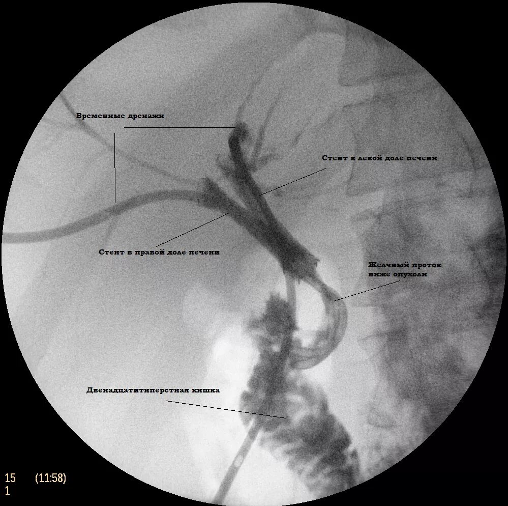 Эндоскопическое стентирование желчных протоков. Эндопротезирование желчных протоков (стентирование). Стентирование желчного протока. Эндоскопия ретроградная панкреатохолангиография. Эндоскопическое стентирование холедоха.