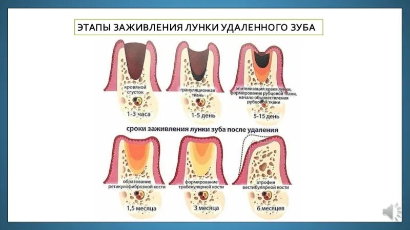 После эти этапы. Как затягивается лунка зуба. Этапы зарастания лунки зуба. Этапы заживления лунки зуба.