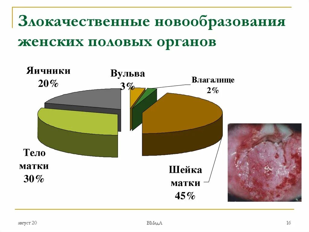 Рак матки статистика. Статистика заболеваний женских половых органов. Злокачественные новообразования половых органов. Факторы риска злокачественных опухолей женских половых органов. Доброкачественные и злокачественные опухоли женских органов.