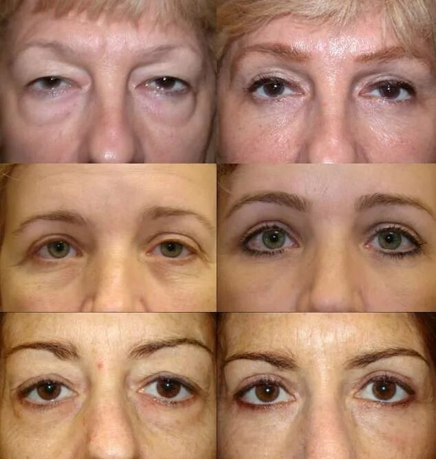 Безоперационная блефаропластика нижних век. Блефаропластики нижних век реабилитация. Неудачная нижняя блефаропластика. Блефаропластика нижних век реабилитация. Блефаропластика нижних век реабилитация по дням.