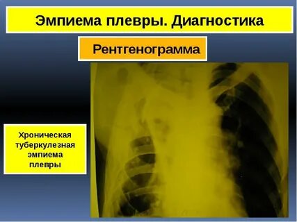 Эмпиема это