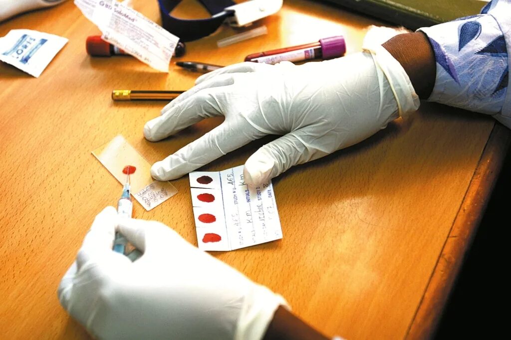 Малярия тестирование. Исследование на малярию. Исследование толстой капли крови на малярию.