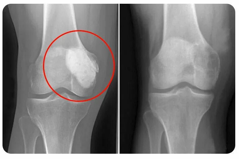 Рак в костях прогноз. Гигантоклеточная опухоль большеберцовой кости. Гигантоклеточная опухоль кости рентген. Остеобластокластома рентген кости. Остеосаркома коленного сустава рентген.