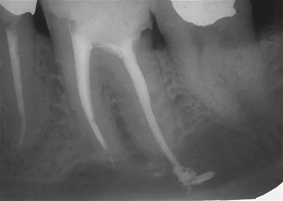 Рассосался корень зуба. Выведение пломбировочного материала за Апекс. Перфорация корневого канала рентген. Воспаление корня зуба на рентгене.