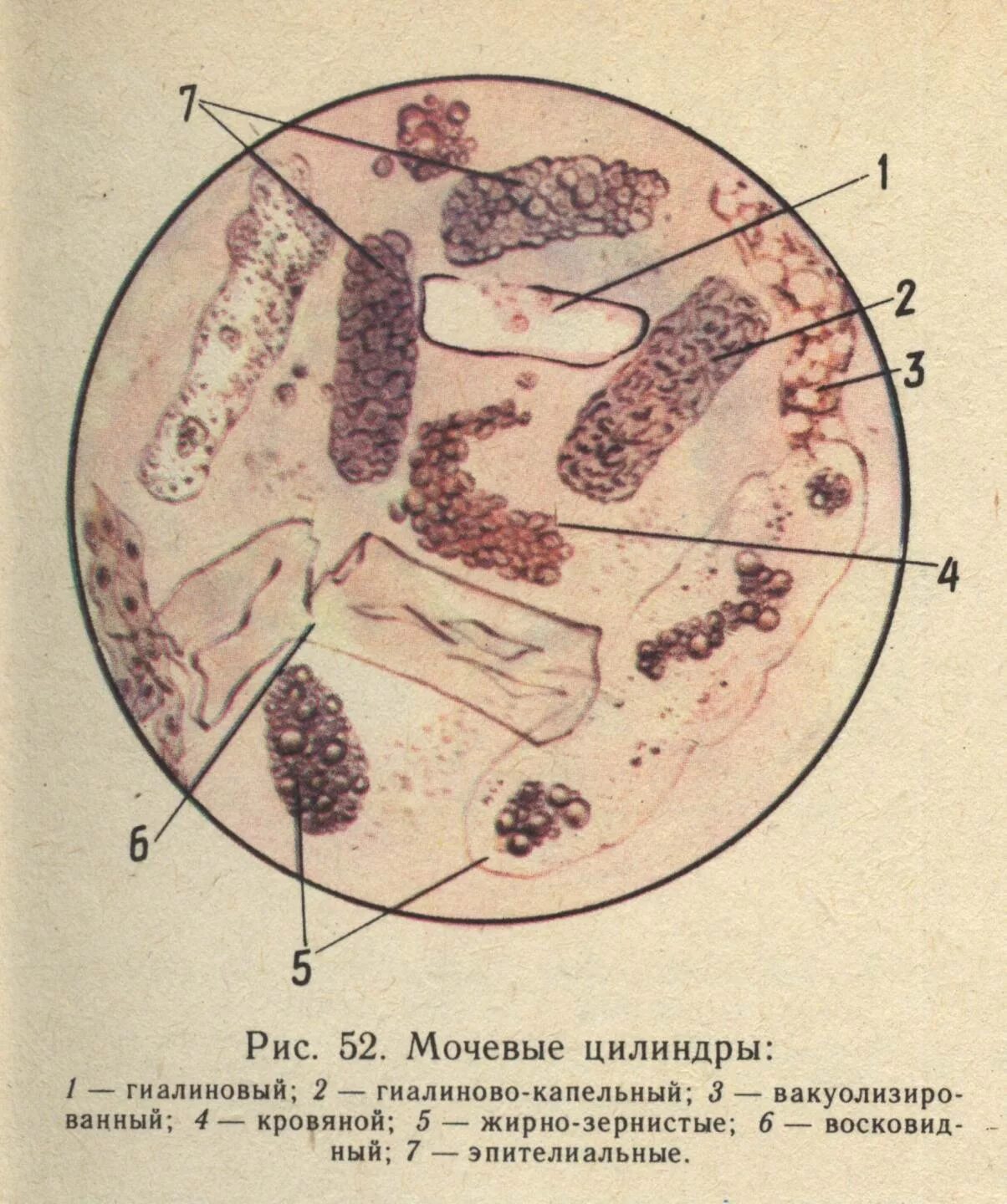 Повышены цилиндры в моче. Гиалиновый цилиндр в моче микроскопия. Микроскопия мочицелиндры. Микроскопия мочи при пиелонефрите. Микроскоп я мочи цилиндр.