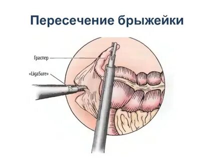 Слабое развитие аппендикса у человека наличие хорды