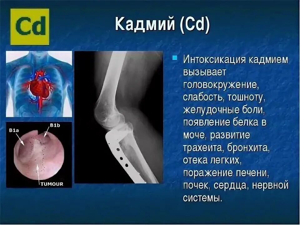 Отравление кадмием симптомы. Воздействие кадмия на организм человека.