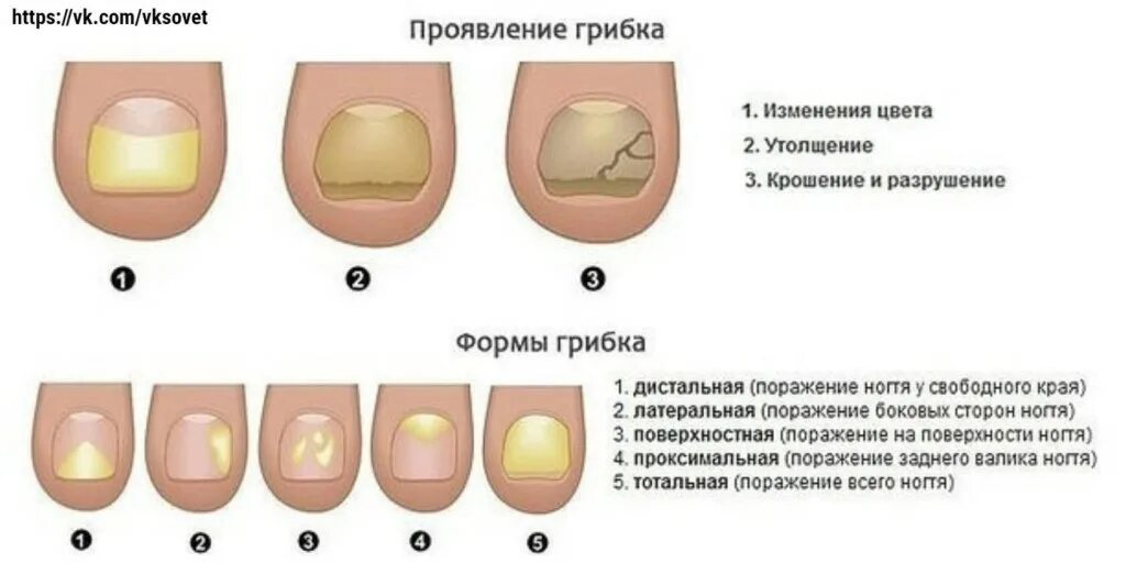 Ногтевые пластины ребристые причина. (Онихомикоз) онихомикоз ногтей. Грибковые болезни ногтей. Грибковые заболевания ногтей на ногах.