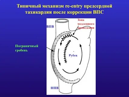 Тахикардия после еды