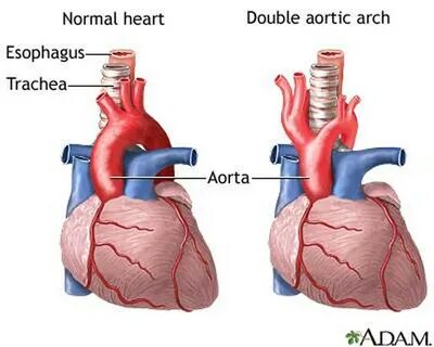 Аорта 4