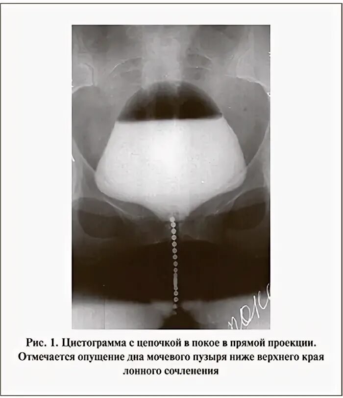 Операция стрессовое недержание мочи