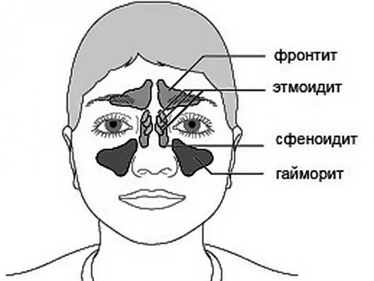 Хронический гайморит этмоидит фронтит. Сфеноидальный синусит симптомы.