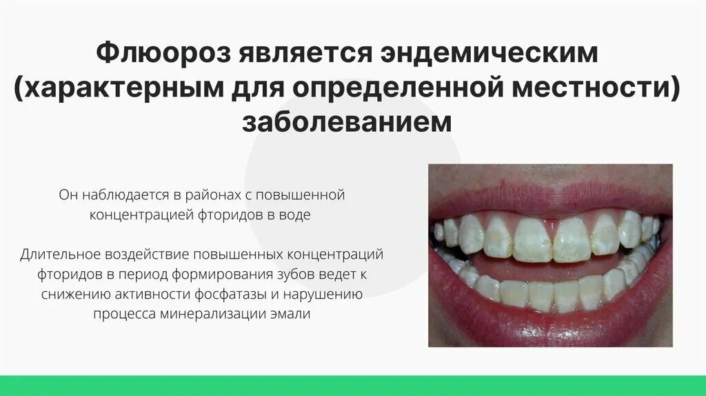 При недостатке фтора в организме развивается ответ. Меловидно-крапчатая форма флюороза зубов.. Эндемический флюороз классификация. Эндемический флюороз зубов классификация.
