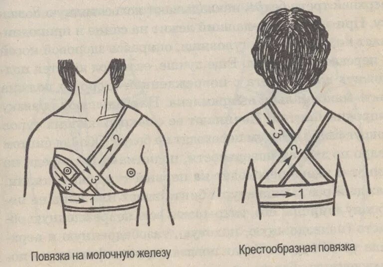 Повязка на молочные железы алгоритм. Наложение повязки на молочную железу. Продемонстрируйте наложение повязки на правую молочную железу. Наложите бинтовую повязку на молочную железу.. Наложение повязки на грудь при мастите.