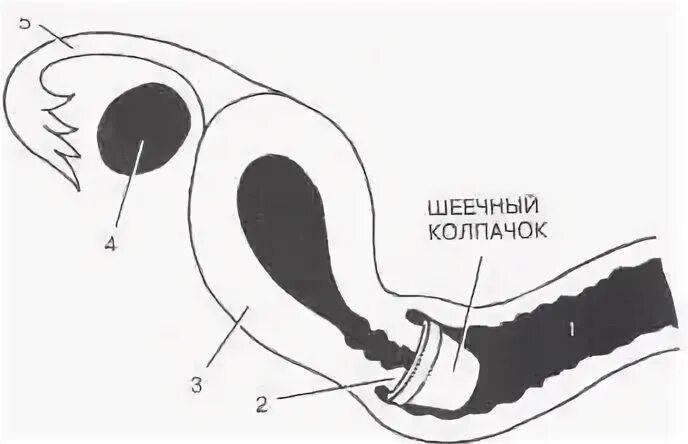 Маточный колпачок