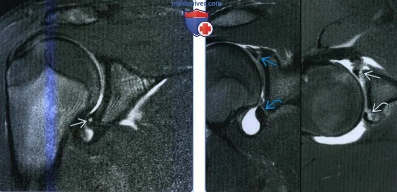 Разрыв губы гленоида плечевого сустава. Повреждение суставной губы плечевого сустава. Разрыв губы гленоида плечевого сустава операция. Хрящевая губа плечевого сустава.