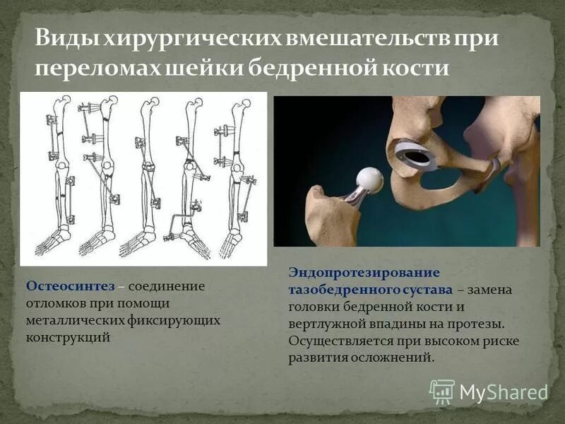 Шейка бедра перелом остеосинтез. Перелом хирургической шейки бедренной кости. Перелом шейки бедра отломки. Перелом бедренной кости лечение. Прогнозы после операции перелома шейки