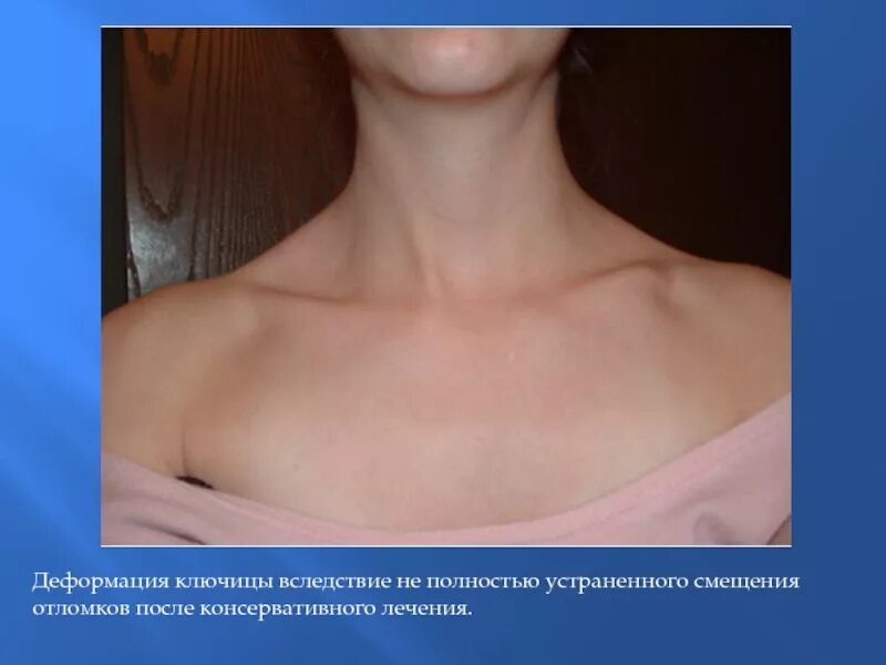 Грудино ключичная артрит. Грудино ключичная артрит