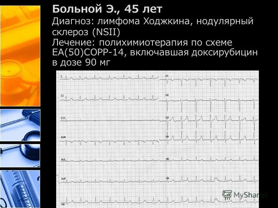 Пациент 65 лет с диагнозом. Лимфома Ходжкина нодулярный склероз. Нодулярный склероз при болезни Ходжкина. Кардиотоксичность. Подходы к диагностике кардиотоксичности.