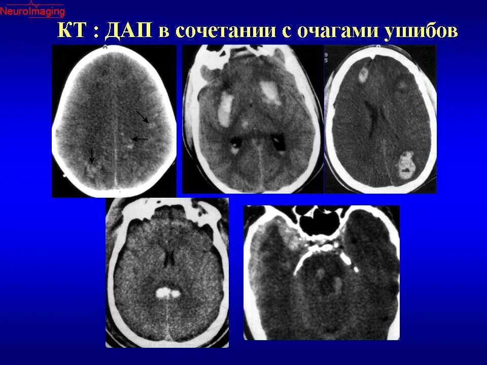 Диффузное аксональное повреждение кт. Аксональные повреждения мрт. Диффузное аксональное повреждение головного мозга кт. Диффузные аксональные повреждения головного мозга мрт. Диффузная травма