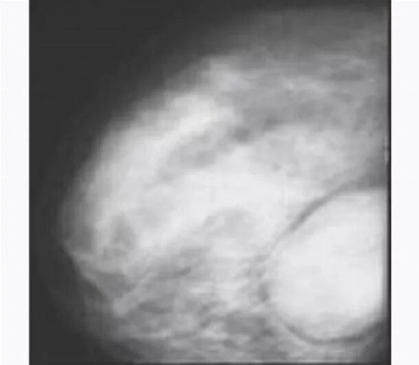 листовидная опухоль молочной