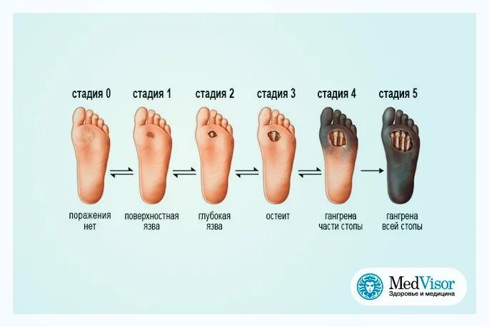 Формы диабетической стопы. Диабетическая стопа стадии. Диабет 1 мкб 10