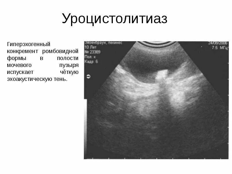 Гиперэхогенные диффузные. Конкременты мочевого пузыря на УЗИ. Гиперэхогенные включения в мочевом пузыре. Гиперэхогенные линейные структуры. Гиперэхогенные образования в мочевом пузыре.