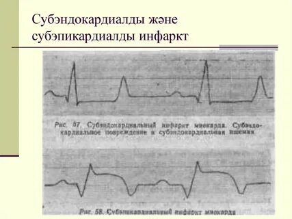 Субэндокардиальный инфаркт