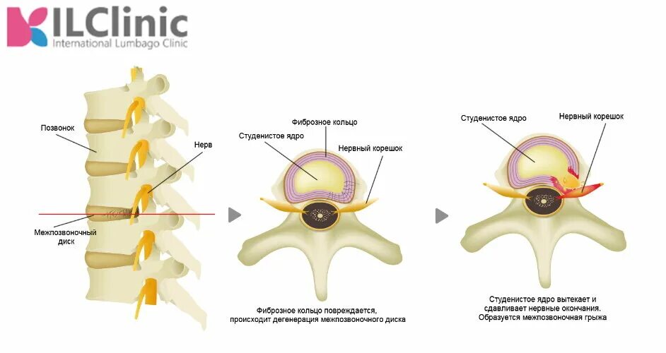 Содержимое межпозвоночного диска. Дорсальные протрузии межпозвонковых дисков. Студенистое ядро межпозвоночного диска. Фиброзное кольцо межпозвоночного диска. Фиброзные кольца межпозвоночных дисков.