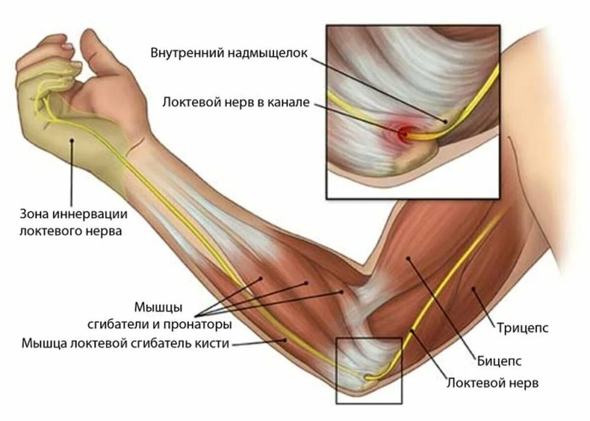 Что делать если сильно болит рука. Локтевой сустав анатомия локтевой нерв. Связки и сухожилия локтевого сустава. Латеральный эпикондилит. Кубитальный туннельный синдром локтевого нерва.