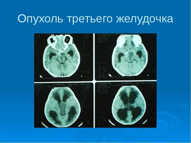 Опухоли желудочков. Опухоли третьего желудочка. Новообразование в третьем желудочке головного мозга. Объемные образования ЦНС.