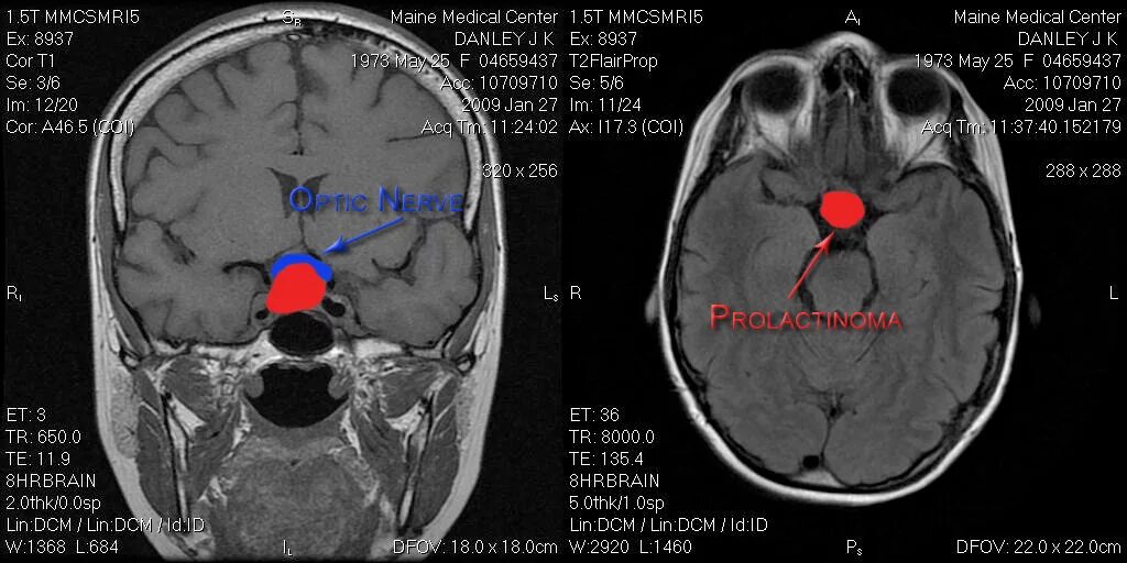 Пролактинома гипофиза мрт. Аденома гипофиза пролактинома. Пролактинома на мрт головного мозга. Микропролактинома гипофиза на мрт. Мрт при повышенном пролактине