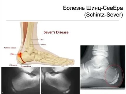 Болезни пяточной кости