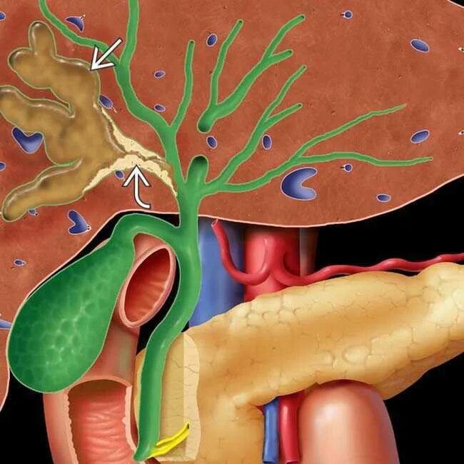 Симптомы забитых желчных протоков. Бактериальный холангит. Хронический склерозирующий холангит. Аутоиммунный билиарный холангит.